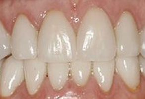 The image shows a close-up view of a person s teeth with an emphasis on their yellowish color and possible staining, which could be indicative of dental health issues such as discoloration or tooth decay.