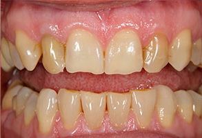 The image shows a close-up view of a person s teeth with a focus on dental treatment, likely indicating a before-and-after scenario for cosmetic dentistry services.