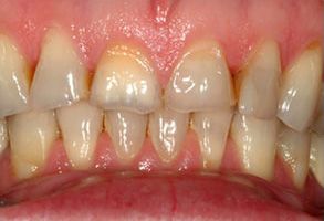 The image displays a close-up view of a person s teeth with visible signs of dental decay and wear, showcasing an oral health issue requiring attention.